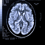Health medical image of an MRI / MRA (Magnetic Resonance Angiogram) of the head showing the brain